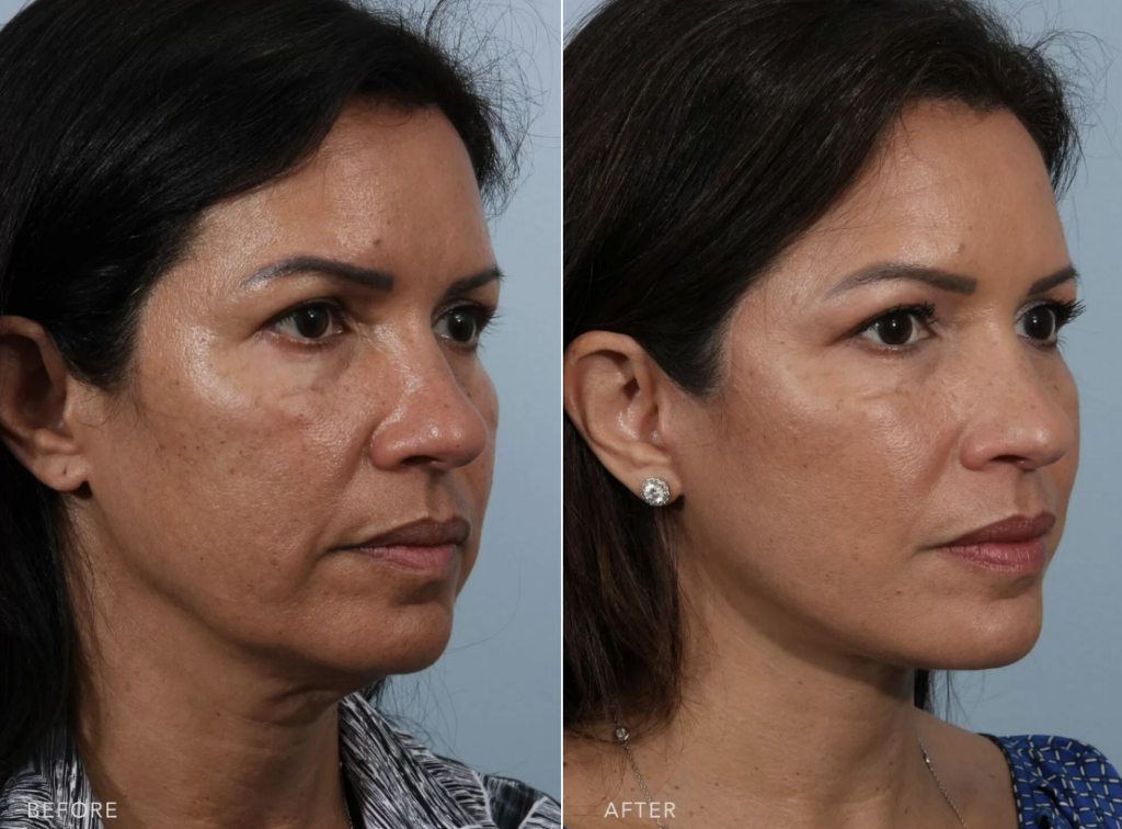 How Much is a Facelift?