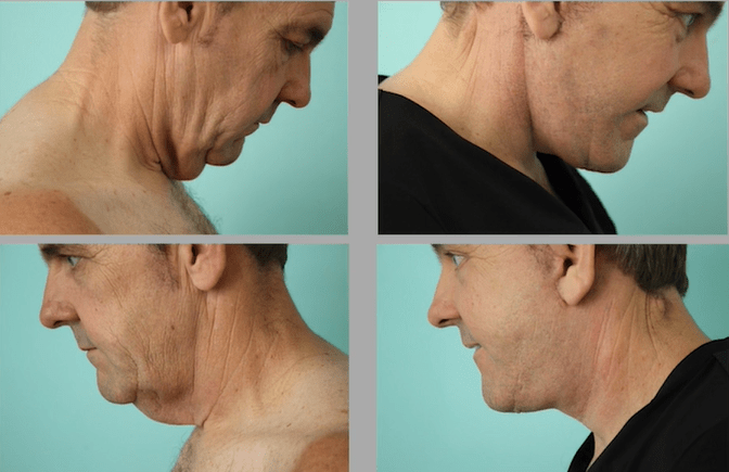 How Much is a Neck Lift?