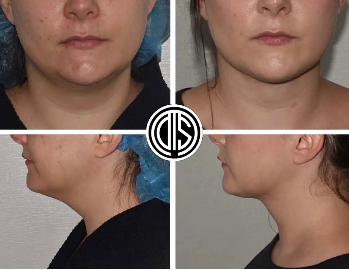 How Much is Chin Lipo?